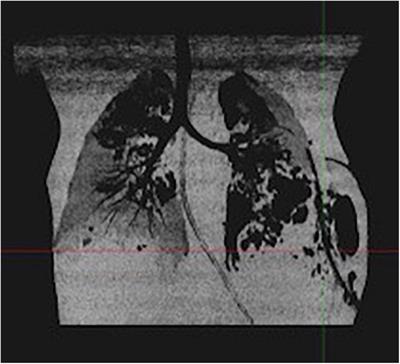 Severe Staphylococcus aureus infections in children: Case reports and management of positive Panton-Valentine leucocidin cases